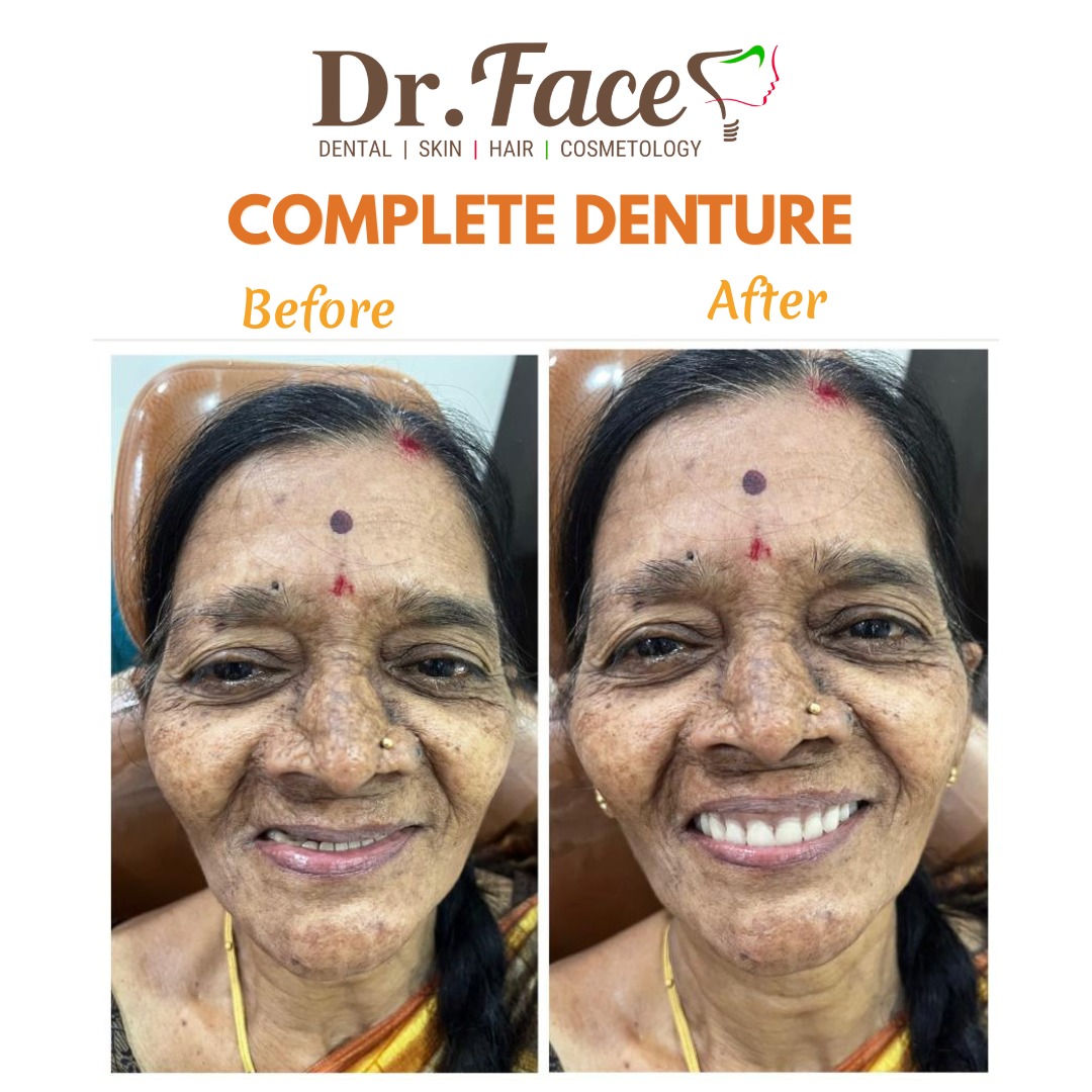 Complete dentures β custom-crafted for a natural, confident smile