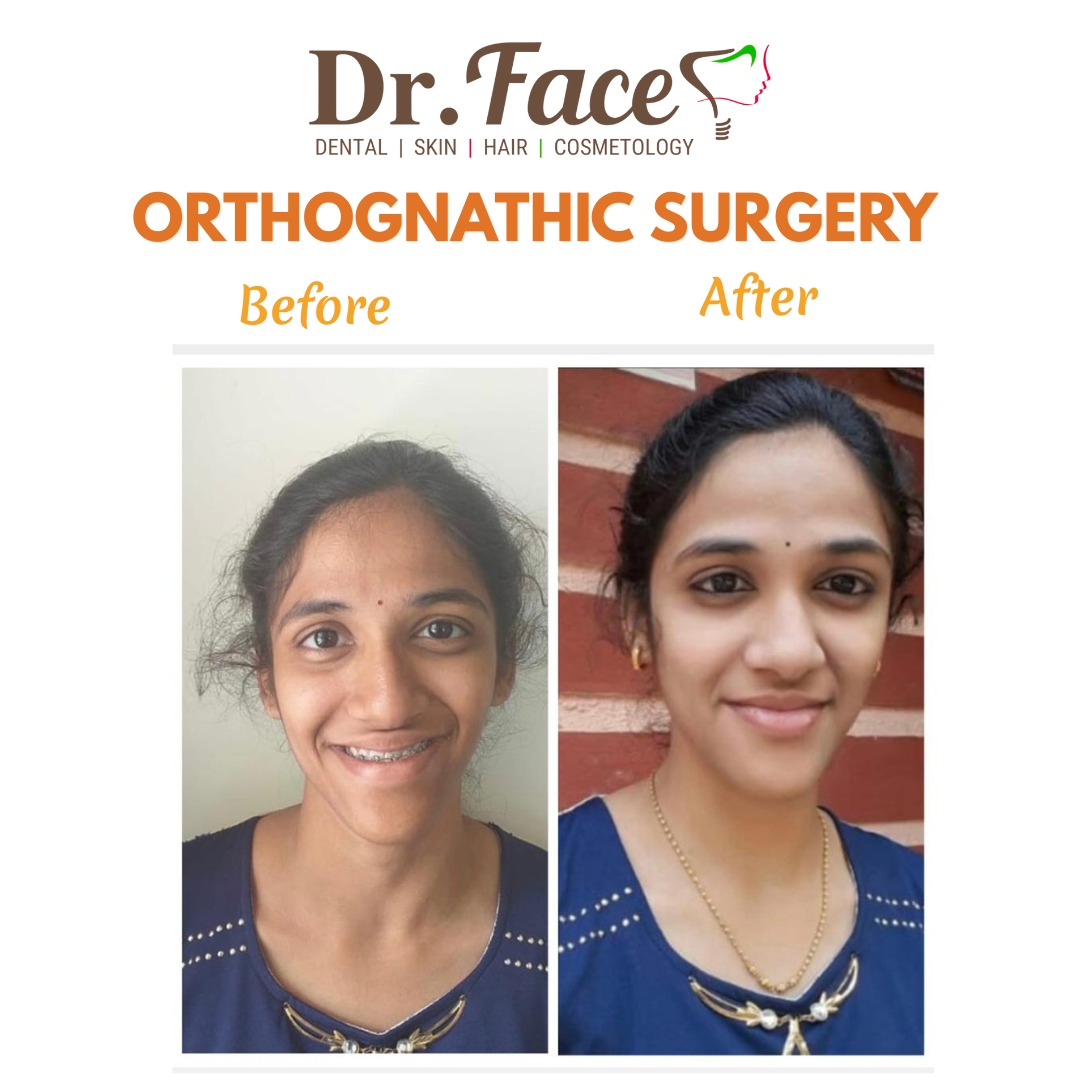 Orthognathic surgery β precise jaw correction for facial harmony