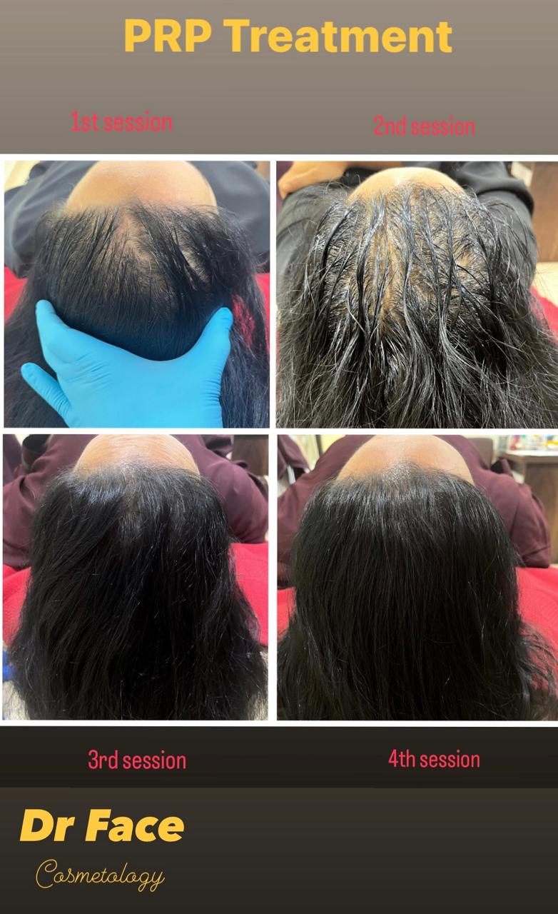 PRP hair therapy β fuller, healthier regrowth in just a few sessions